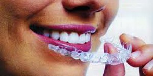 Orthodontie adulte